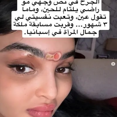 رومي القحطاني تصدم متابعيها بإصابة مشوّهة في وجهها وتكشف عن معاناتها المستمرة