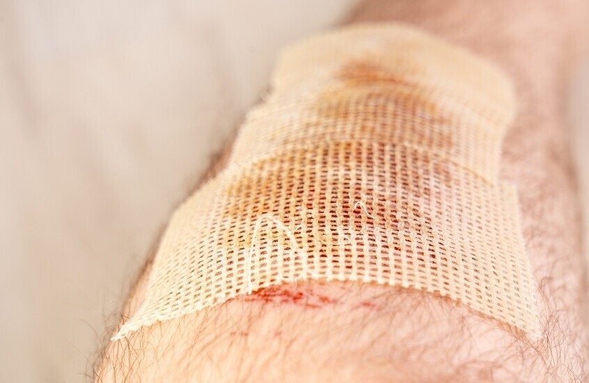 تقنية جديدة تعزز شفاء الجروح عبر تنشيط خلايا الجلد