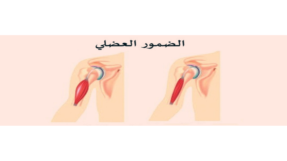 ابتكار دواء جديد لعلاج ضمور العضلات باستخدام الإكسوسومات في روسيا