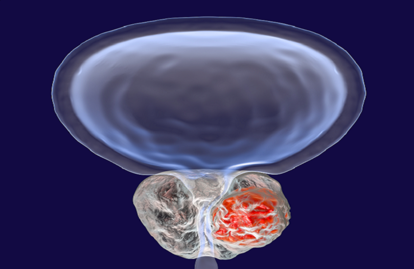 اكتشاف جديد حول جزيئات الحمض النووي الريبوزي وتأثيرها على سرطان البروستاتا