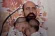 ثورة الطب الرقمي فصل التوائم السيامية بتقنيات الواقع الافتراضي