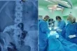 جراحة معقدة في العراق لاستخراج مئات الاجسام المعدنية من معدة مريض